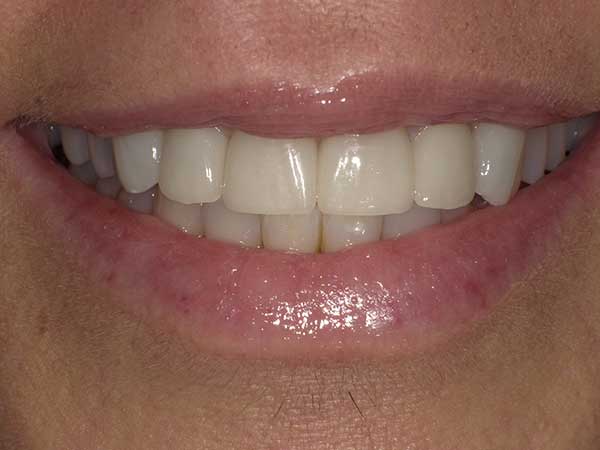 Photo of a patient after treatment at Prosthodontic Associates of Long Island 