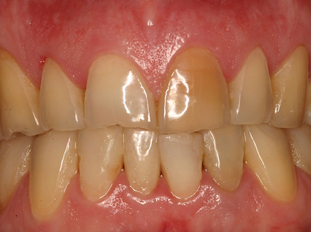 Photo of a patient before treatment at Prosthodontic Associates of Long Island 