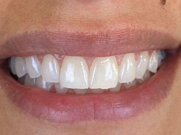 Photo of a patient before treatment at Prosthodontic Associates of Long Island 