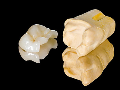 Dental inlays and onlays by dentist in Lake Success, NY.